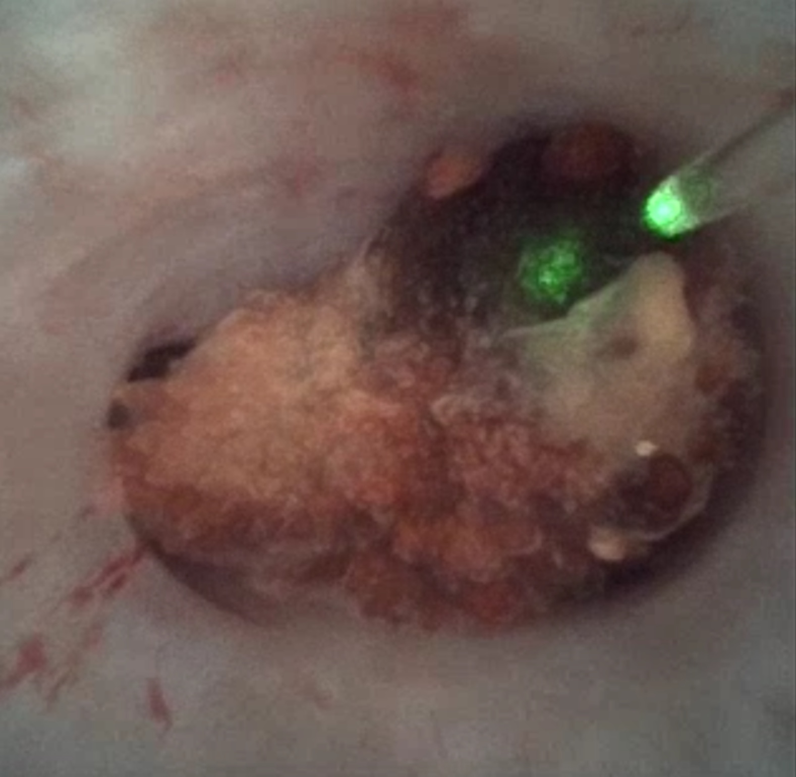 Dr Hadjipavlou performing ureteroscopic laser lithotripsy