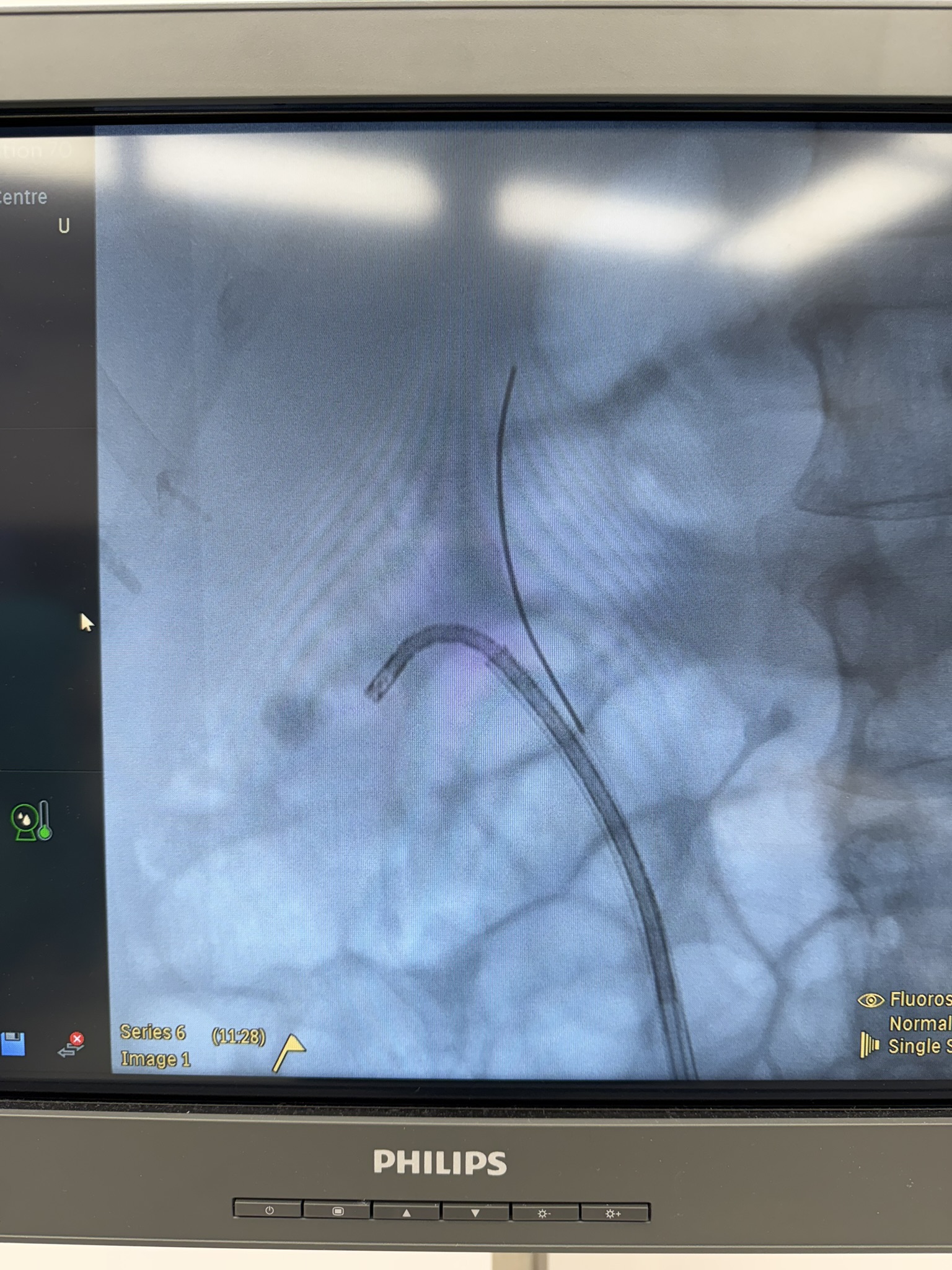 Dr Hadjipavlou performing ureteroscopic laser lithotripsy