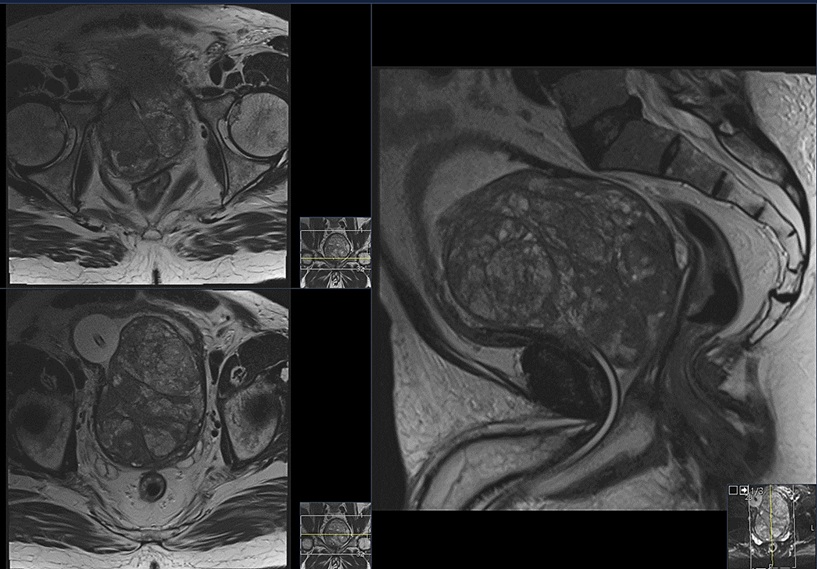 MRI of a large prostate suitable for HoLEP